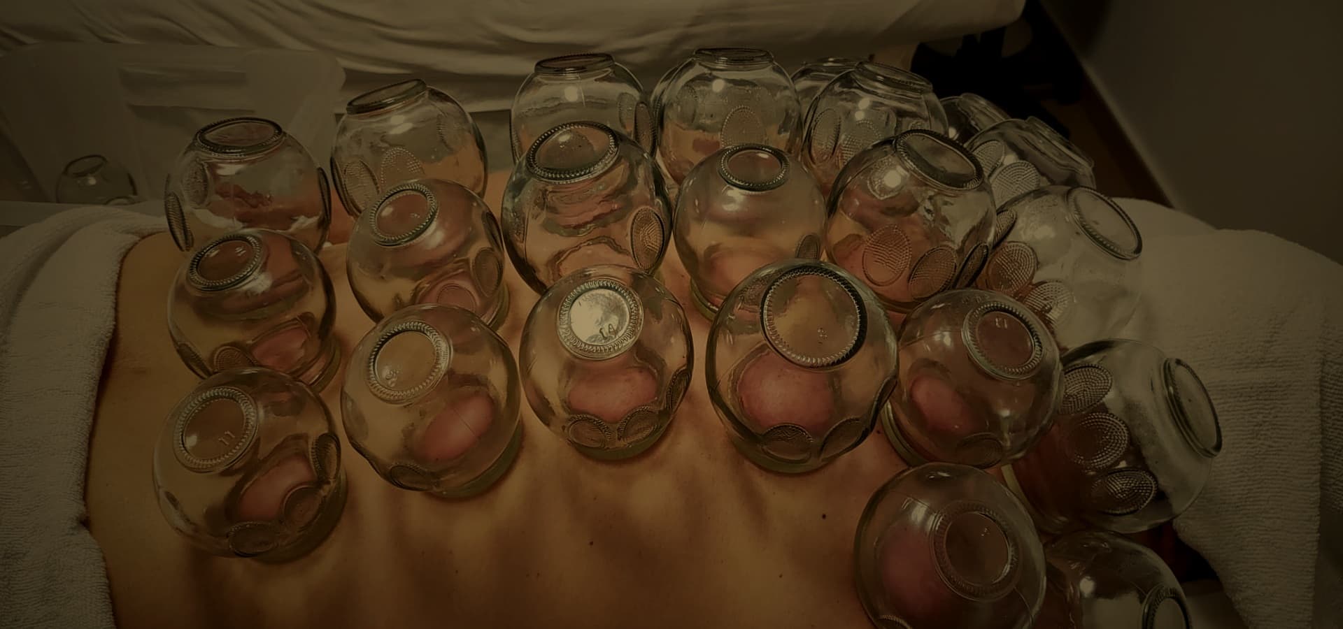 Cupping